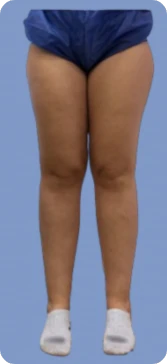 Lipedema etapa 1
