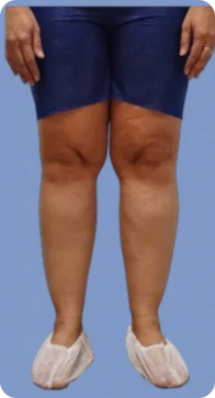 Lipedema etapa 2