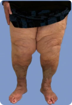 Lipedema etapa 4