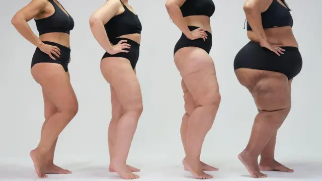 Etapas del lipedema